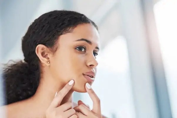 WAYS BLACK WOMEN CAN MANAGE HORMONAL ACNE